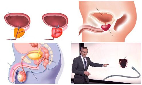 sveika ir serganti prostata